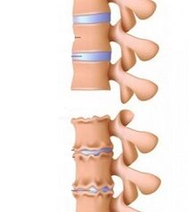 Štádiá rampy osteochondrózy krku