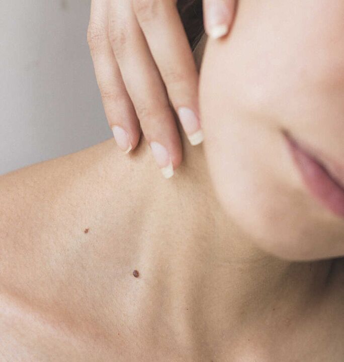 Tuhosť v krku je jedným z príznakov počiatočného štádia osteochondrózy krčnej chrbtice