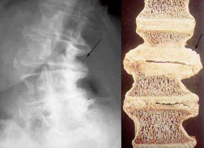 poškodenie stavcov pri hrudnej osteochondróze