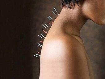 Reflexoterapia je účinná metóda liečby cervikálnej osteochondrózy