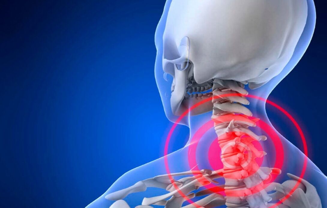osteochondróza krčnej chrbtice